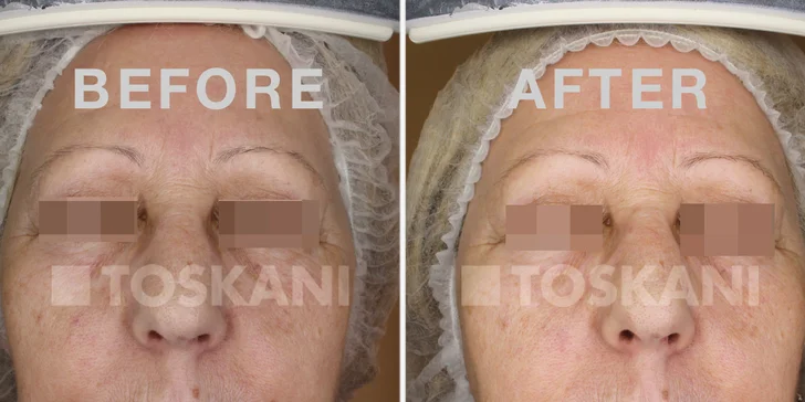 Omladnite a revitalizujte svoje vlasy s účinnou mezoterapiou v Toskani Beauty Center