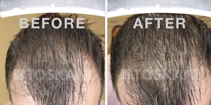 Omladnite a revitalizujte svoje vlasy s účinnou mezoterapiou v Toskani Beauty Center
