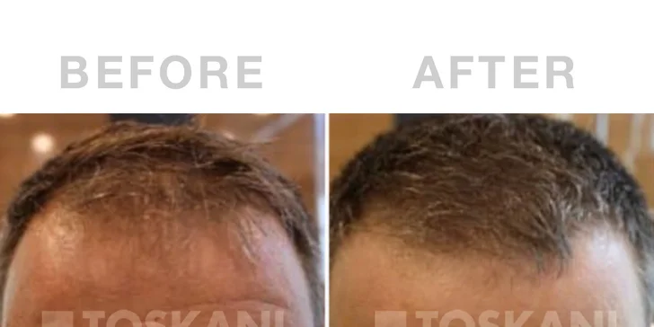 Omladnite a revitalizujte svoje vlasy s účinnou mezoterapiou v Toskani Beauty Center