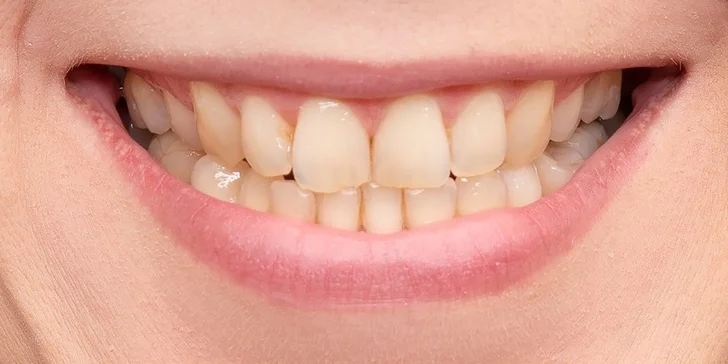 Dentini: Dentálna hygiena pre deti aj dospelých alebo bielenie zubov