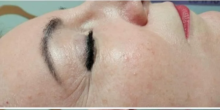 Vyhladenie vrások podľa tradičnej čínskej medicíny