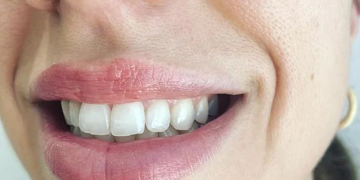 Dentini: Dentálna hygiena pre deti aj dospelých alebo bielenie zubov