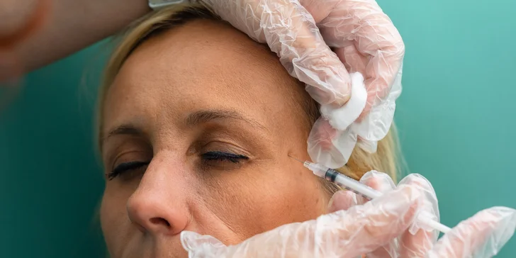 Aplikácia botulotoxínu DYSPORT do oblasti medziobočia, čela alebo okolia očí