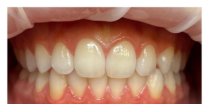 Dentálna hygiena či ambulantné bielenie zubov
