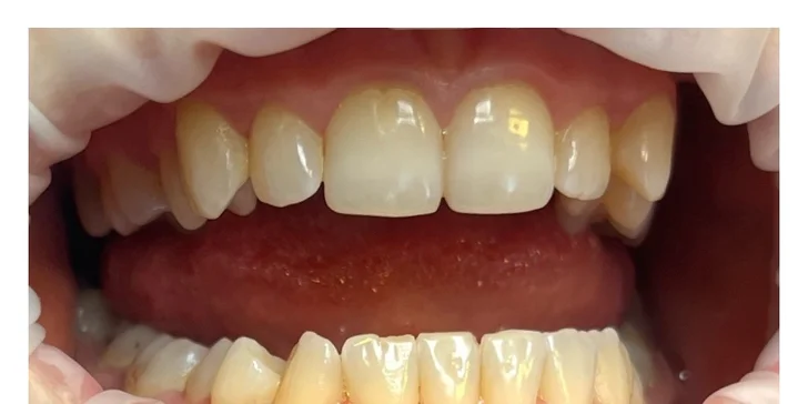 Dentálna hygiena či ambulantné bielenie zubov