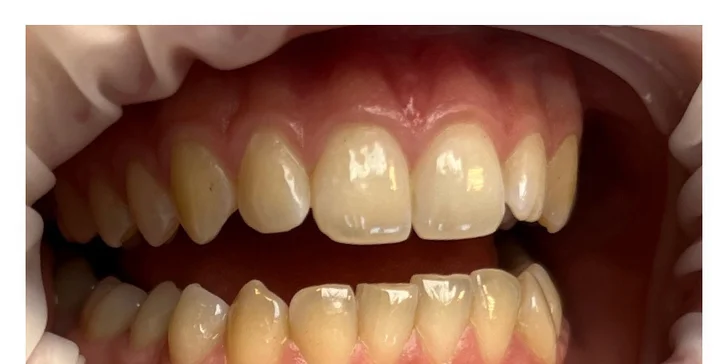 Dentálna hygiena či ambulantné bielenie zubov