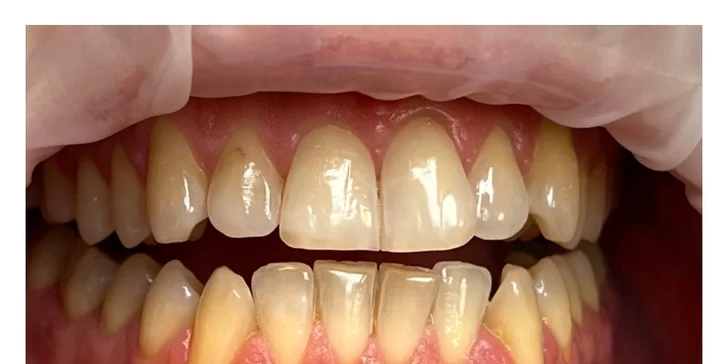 Dentálna hygiena či ambulantné bielenie zubov