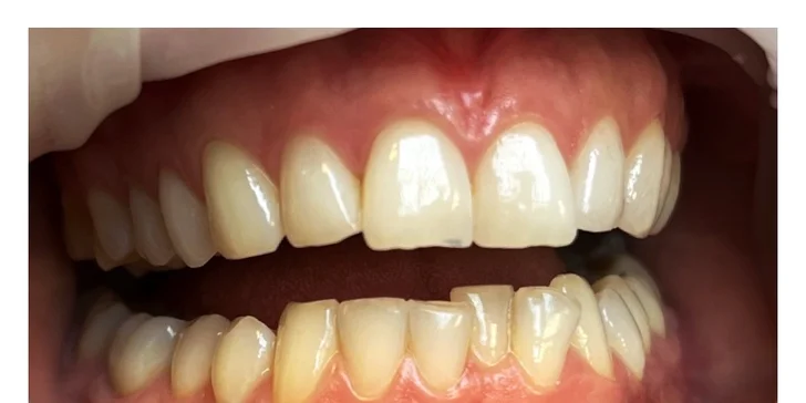Dentálna hygiena či ambulantné bielenie zubov