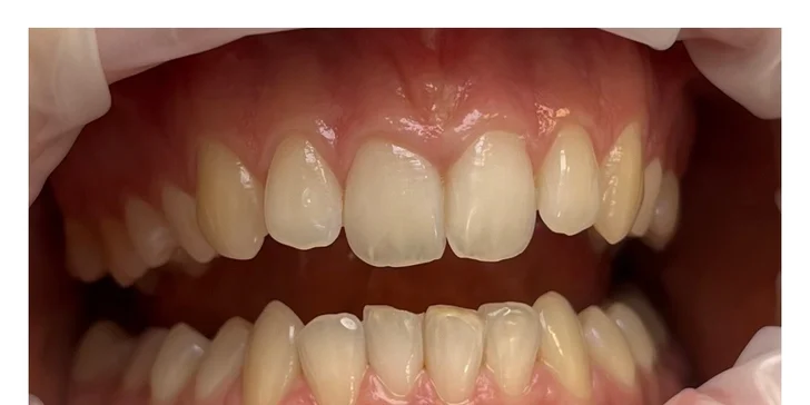 Dentálna hygiena či ambulantné bielenie zubov