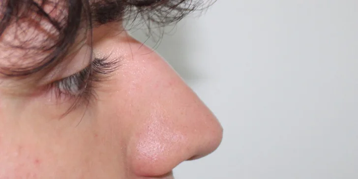 Jednoduchá či kompletná rhinoplastika nosa vykonávaná plastickým chirurgom v Scarlett Clinic