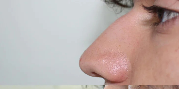 Jednoduchá či kompletná rhinoplastika nosa vykonávaná plastickým chirurgom v Scarlett Clinic