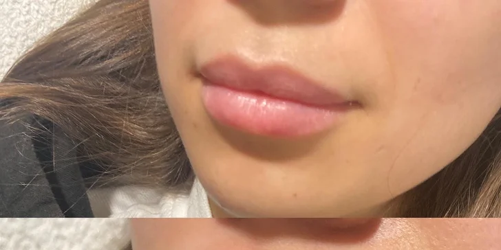 Výplň vrások alebo zvýraznenie pier kyselinou hyalurónovou v Scarlett clinic