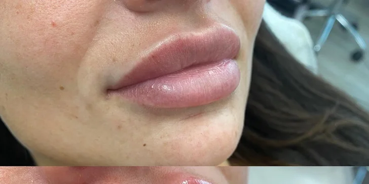 Výplň vrások alebo zvýraznenie pier kyselinou hyalurónovou v Scarlett clinic