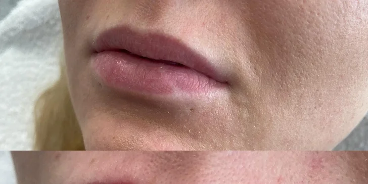 Výplň vrások alebo zvýraznenie pier kyselinou hyalurónovou v Scarlett clinic