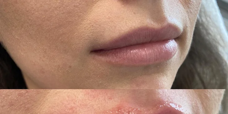 Výplň vrások alebo zvýraznenie pier kyselinou hyalurónovou v Scarlett clinic