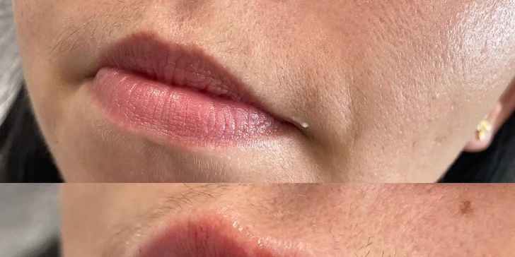 Výplň vrások alebo zvýraznenie pier kyselinou hyalurónovou v Scarlett clinic