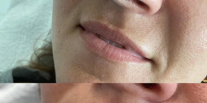 Výplň vrások alebo zvýraznenie pier kyselinou hyalurónovou v Scarlett clinic