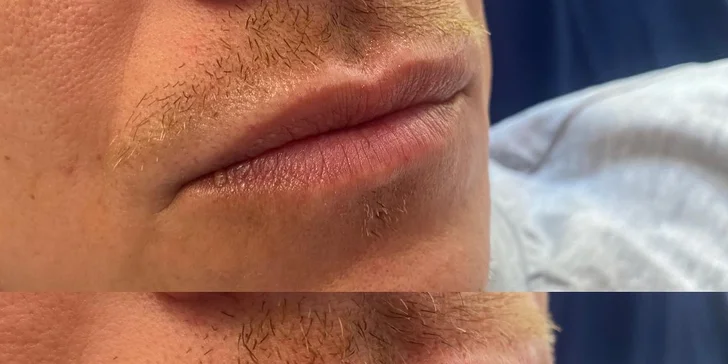 Výplň vrások alebo zvýraznenie pier kyselinou hyalurónovou v Scarlett clinic
