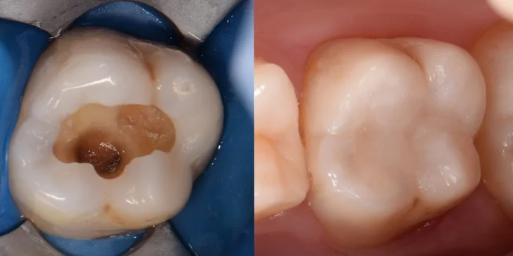 Zbehnite si po krásny úsmev: dentálna hygiena s pieskovaním v Scarlett Clinic