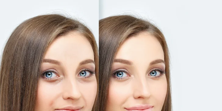 Beautifikácia tváre pomocou kyseliny hyalurónovej v DermaFresh