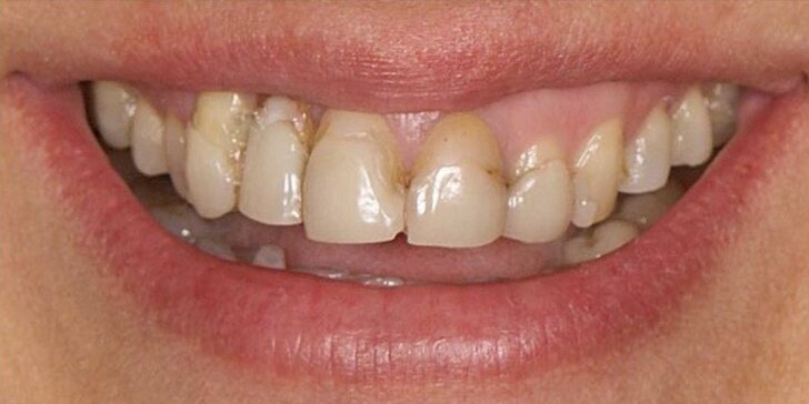 Bielenie zubov, dentálna hygiena alebo zirkónová korunka