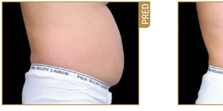Zbavte sa nežiadúceho tuku natrvalo - laserová liposukcia