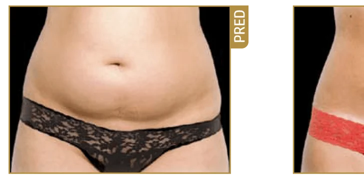 Zbavte sa nežiadúceho tuku natrvalo - laserová liposukcia