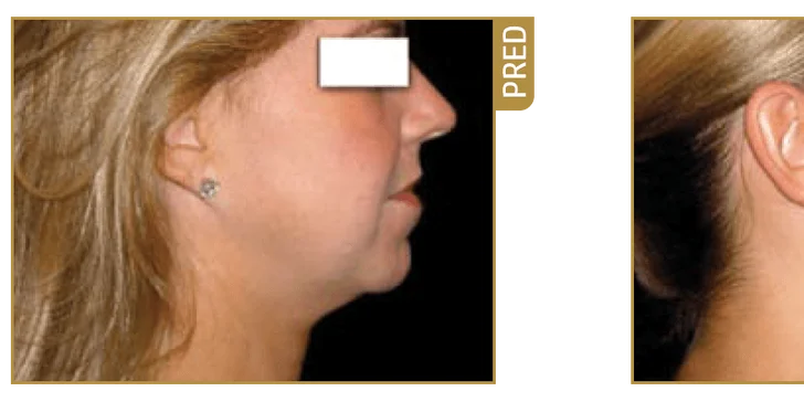 Zbavte sa nežiadúceho tuku natrvalo - laserová liposukcia