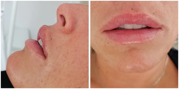 Zväčšenie pier, výplň vrások, mezoterapia alebo botulotoxín