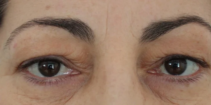 Operácia horných viečok v Scarlett clinic
