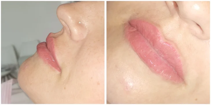 Zväčšenie pier, výplň vrások, mezoterapia alebo botulotoxín
