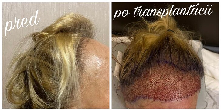 Medicínska turistika: Transplantácia vlasov v Istanbule s plným servisom