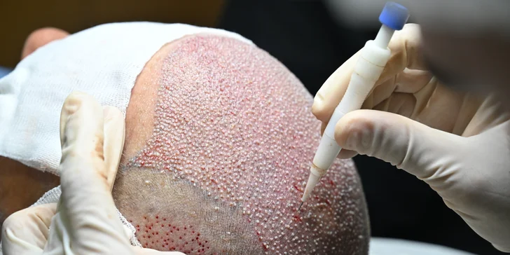 Medicínska turistika: Transplantácia vlasov v Istanbule s plným servisom