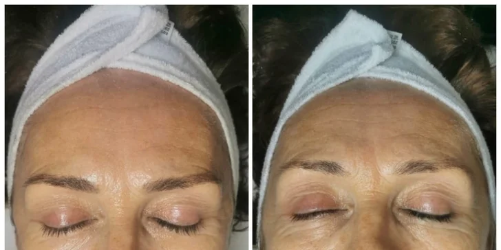 Lash lift rias, Mezoterapia alebo hĺbkové čistenie pleti