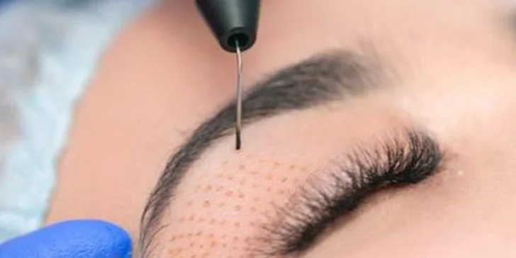Plasma Pen: zbavte sa vrások pomocou plazmového pera