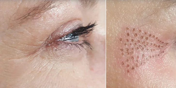 Plasma Pen: zbavte sa vrások pomocou plazmového pera