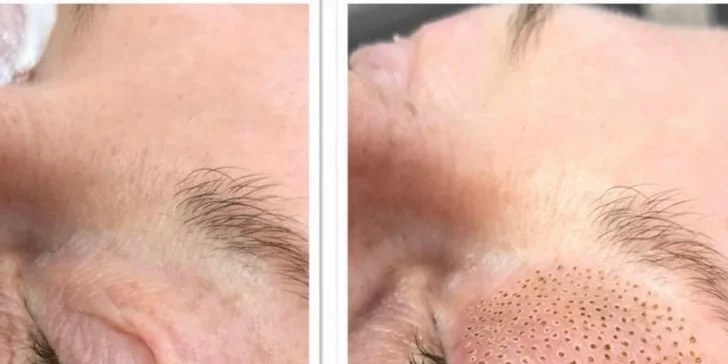 Plasma Pen: zbavte sa vrások pomocou plazmového pera