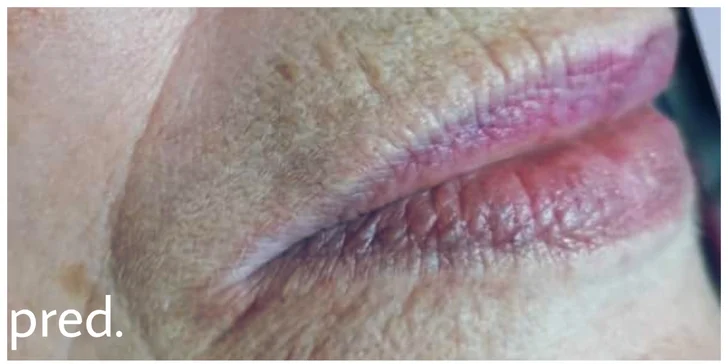 Plasma Pen: zbavte sa vrások pomocou plazmového pera