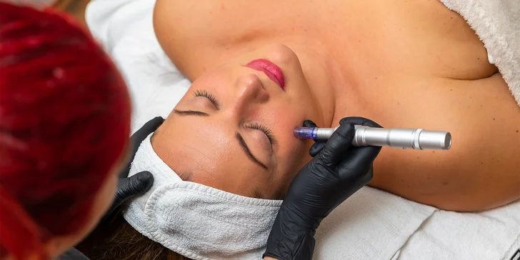 Mezoterapia tváre, tela alebo vlasov pomocou dermapenu