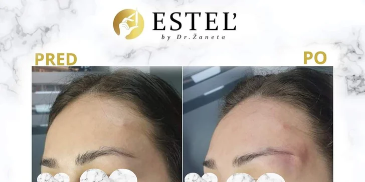 Líščie oči "fox eyes" či niťový lifting tváre pre omladenie