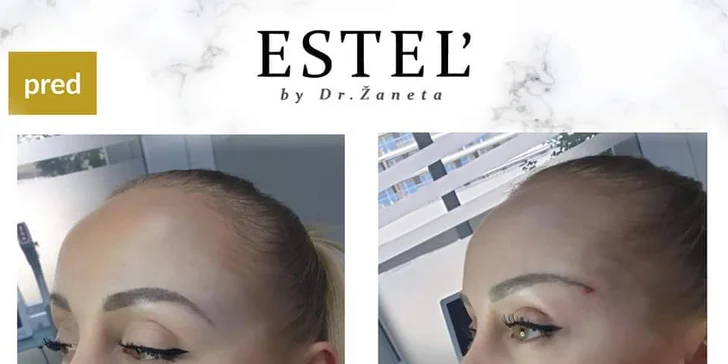 Líščie oči "fox eyes" či niťový lifting tváre pre omladenie