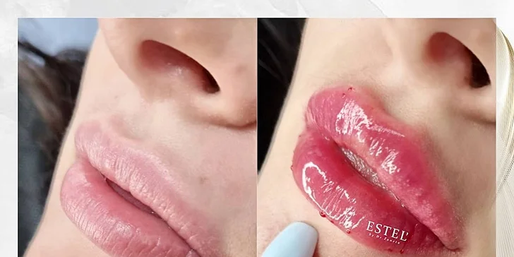 Výplň pier kyselinou hyalurónovou metódou Stripp Lips aj s korekciou vybranej oblasti tváre