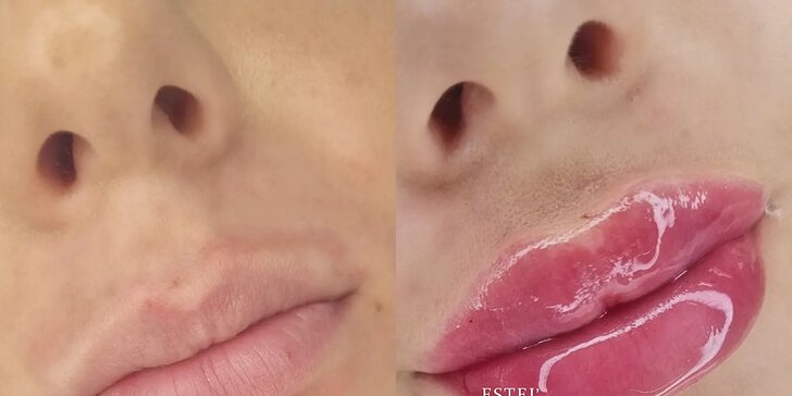 Výplň pier kyselinou hyalurónovou metódou Stripp Lips aj s korekciou vybranej oblasti tváre