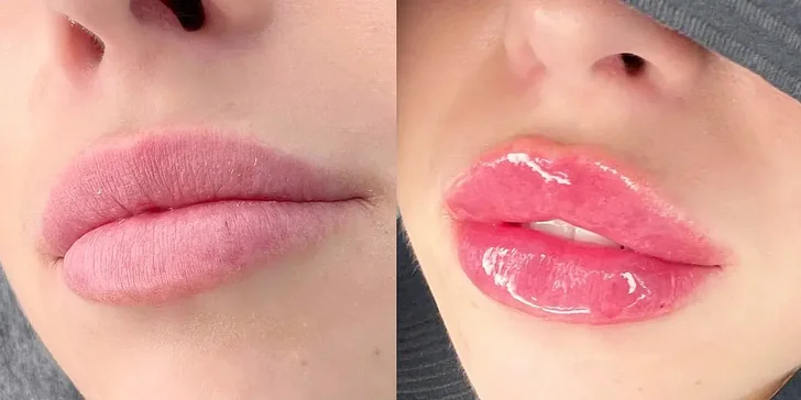 Výplň pier kyselinou hyalurónovou metódou Stripp Lips aj s korekciou vybranej oblasti tváre