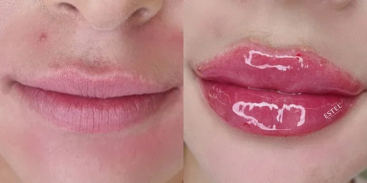 Výplň pier kyselinou hyalurónovou metódou Stripp Lips aj s korekciou vybranej oblasti tváre