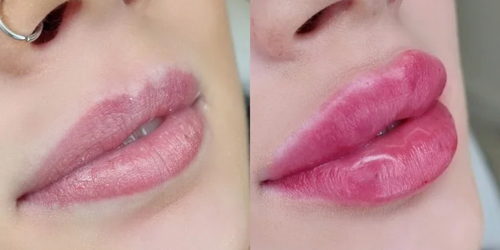 Výplň pier kyselinou hyalurónovou metódou Stripp Lips aj s korekciou vybranej oblasti tváre