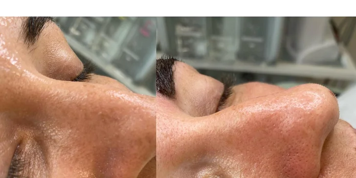 Ošetrenie pleti: Hydrafacial, mezoterapia a mikrodermabrázia v salóne Amenity
