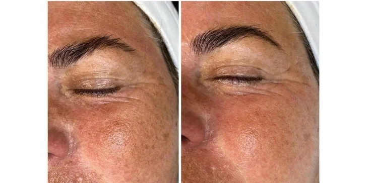 Ošetrenie pleti: Hydrafacial, mezoterapia a mikrodermabrázia v salóne Amenity