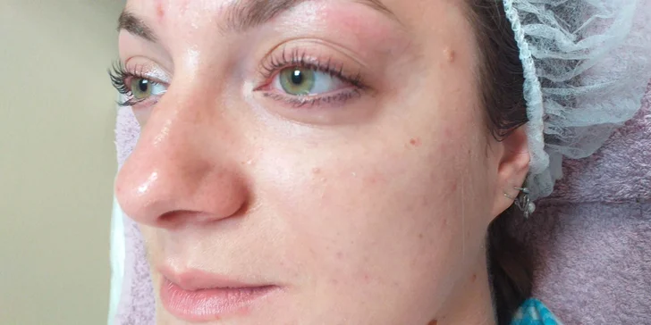 Diamantová mikrodermabrázia, Lash Lifting a iné ošetrenia