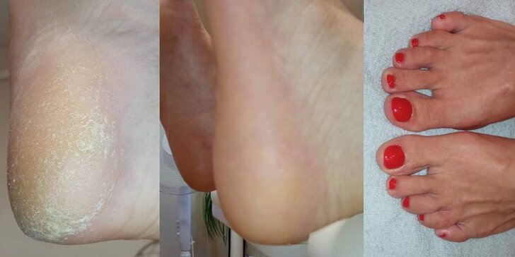 Tri druhy pedikúry alebo nechtová protetika pre krásu vašich nôh